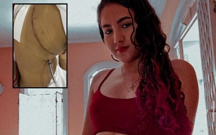 Jovem de 19 anos contrai fungos no pulmão por uso de narguilé e passa por cirurgia