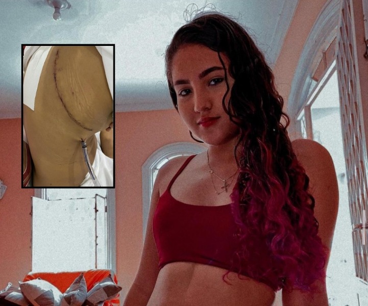 Jovem de 19 anos contrai fungos no pulmão por uso de narguilé e passa por cirurgia