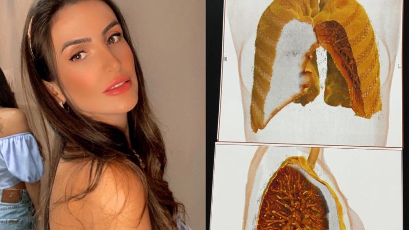 Sorriso: Empresária tem pulmão perfurado após realizar sessão de acupuntura